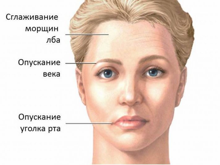 Паралич половины лица. О чем следует думать.