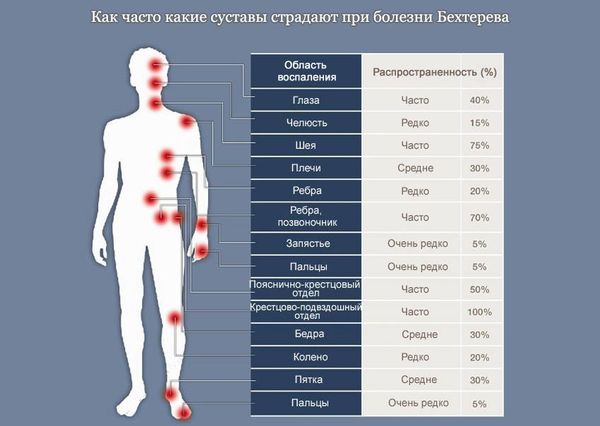 Болезнь Бехтерева — причина боли в спине!